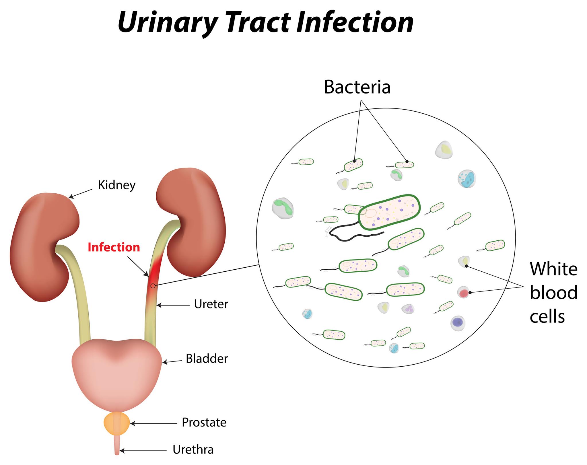 UTI Treatment for Women in Bhopal