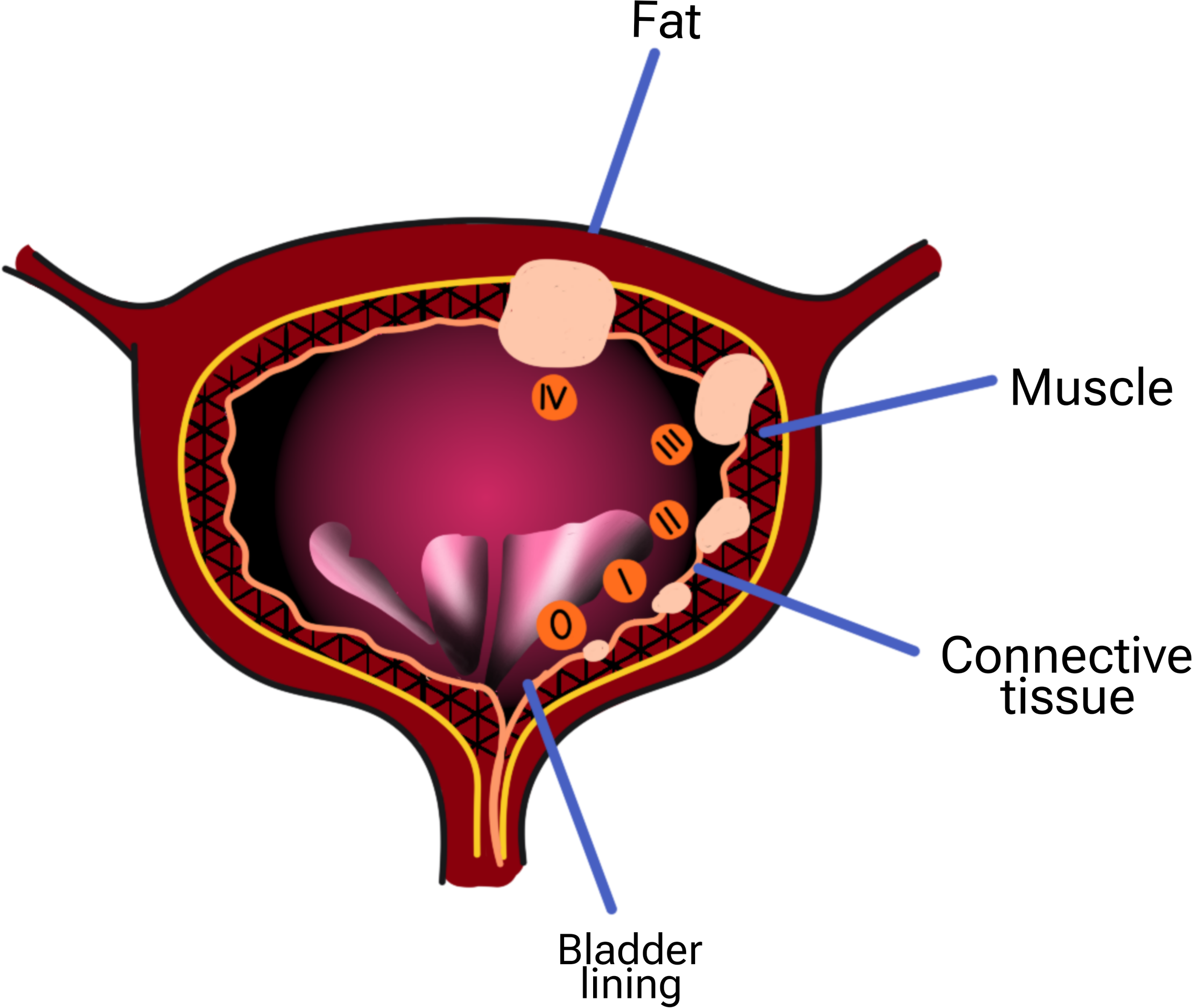 Bladder Cancer Treatment in Bhopal