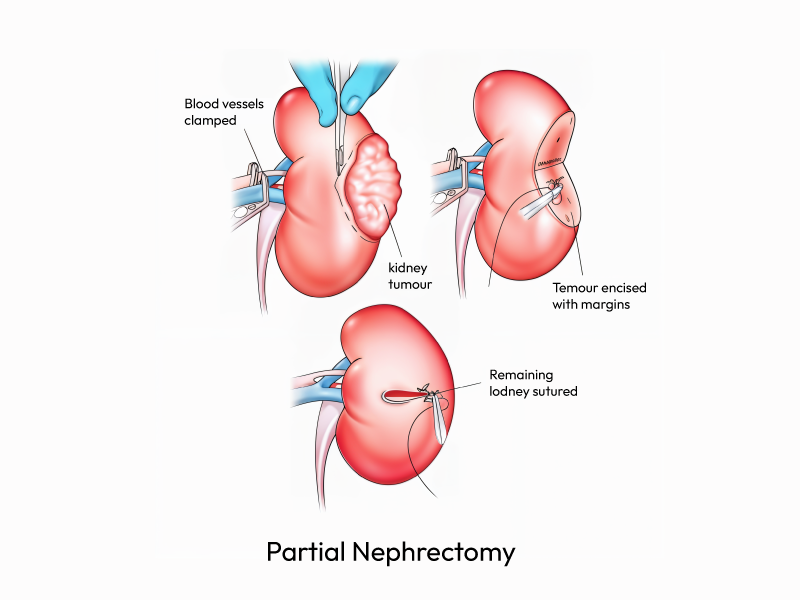 Kidney Cancer Surgery in Bhopal